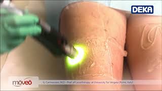 Moveo Technology for laser hair removal Thighs [upl. by Muhammad]