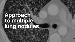 Algorithmic Approach to Multiple Lung Nodules [upl. by Rosenbaum781]