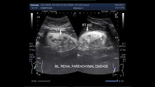 Bilateral Renal Parenchymal Disease Two videos [upl. by Glory833]