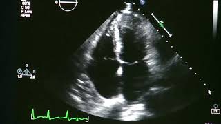 Atrial Fibrillation On Echocardiogram [upl. by Awahsoj]