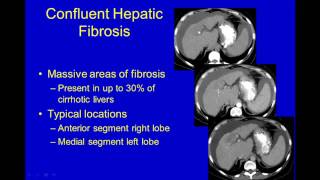 Ultrasound of Diffuse Liver Disease [upl. by Kendy]