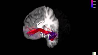 Uncinate Fasciculus Tracts Overlaid on an Anatomical T1Weighted Image [upl. by Pail]