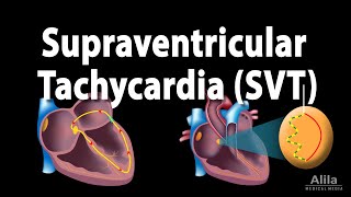 Supraventricular Tachycardia SVT PSVT Animation [upl. by Garrard]