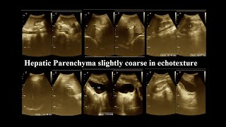 Coarse hepatic parenchymal  Ultrasonography report  liver disease  Amader Hospital  P1 [upl. by Icam]