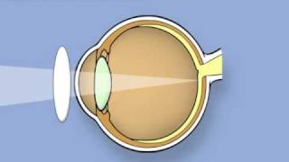 Retinoscopy of the eye Ophthalmology [upl. by Tyra]