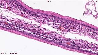 Mucinous Cystadenoma Ovary  Histopathology [upl. by Bax]