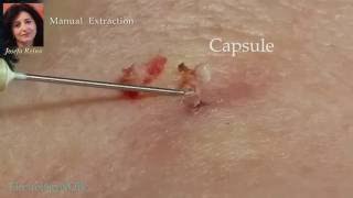 Josefa Removal of a Sebaceous Cyst gigantic blackhead [upl. by Laehcym]