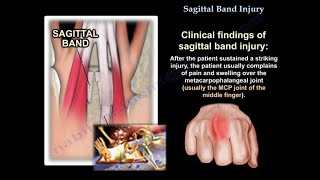 Sagittal Band Injury  Everything You Need To Know  Dr Nabil Ebraheim [upl. by Marga]